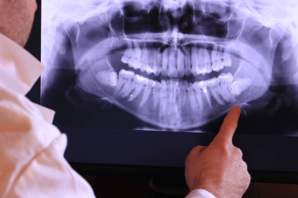 Best Knocked-Out Tooth (Avulsed Tooth) Treatment in Fisher, IL